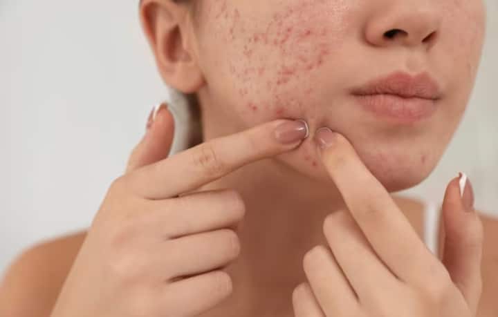 सूखे फल और कैंडीज: मार्केट में स्ट्राबेरी, आम, इमली, कीवी, संतरे जैसे स्वादिष्ट फल सूखाकर बेचे जाते हैं. इन सूखे फलों के टुकड़ों को टेस्टी बनाने के लिए इनमें चीनी लगा दिया जाता है. जब इन ड्राइड फ्रूट्स का सेवन करते हैं तो सीबम का उत्पादन ज्यादा होता है, जिससे सूजन बढ़ती है और एक्ने की समस्या बढ़ जाती है.