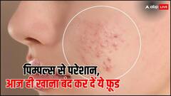Pimple's Remedy: पिंपल्स-एक्ने से पाना है छुटकारा तो आज से ही खाना बंद कर दें 5 फूड्स