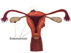 Endometriosis: Causes, Symptoms And Treatment