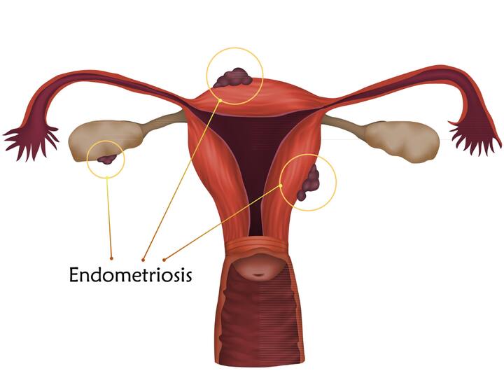 Endometriosis is a painful, non-malignant disease. (Image source: getty images)
