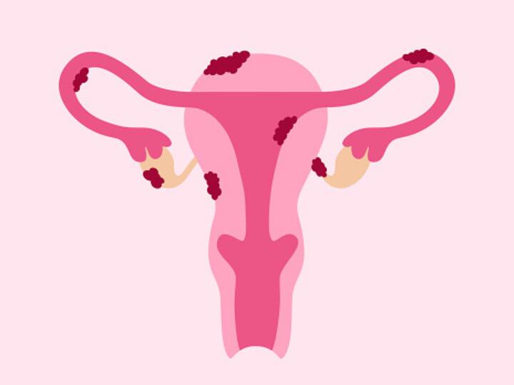 It occurs due to the presence of tissue similar to that lining the uterus (endometrium) being present in abnormal sites, most commonly on the ovary and behind the uterus or on the lining of the abdominal organs (peritoneum).  (Image source: getty images)