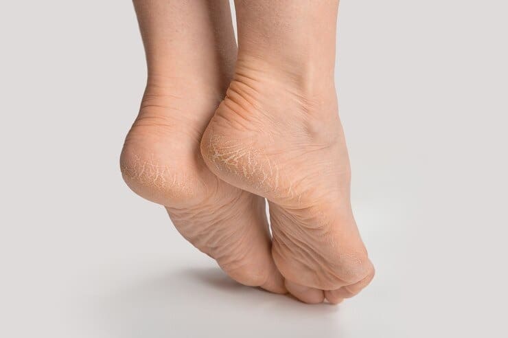if your heel are cracking in summer then start this home remedies Cracked Heels: गर्मियों में भी फट रही है आपकी एड़ियां तो आज से शुरू करें ये घरेलू उपाय