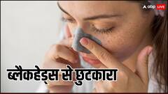 Blackheads Removal Tips: ब्लैकहेड्स से आप भी हैं परेशान, तो जरूर करें यह आसान काम