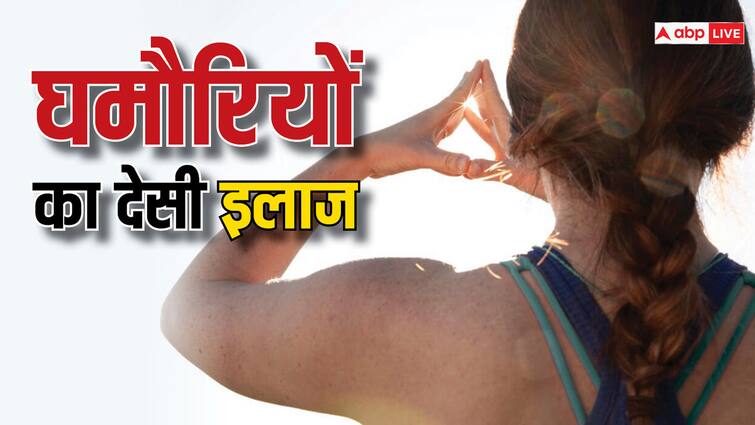 चुभती जलती घमौरियों का काल हैं ये 5 घरेलू नुस्खे, आज़माते ही मिलेगा आराम