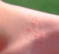 Summer Health Tips: ਗਰਮੀਆਂ 'ਚ ਪਿੱਤ ਤੋਂ ਬਚਣ ਲਈ ਅਪਣਾਓ ਇਹ ਨੁਸਖੇ, ਮਿਲੇਗੀ ਰਾਹਤ