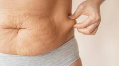 स्ट्रेच मार्क्स से हो हैं परेशान? इन्हें हटाने के लिए ये घरेलू उपाय ही काफी हैं!