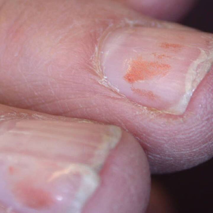 ਪ੍ਰੋਟੀਨ ਦੀ ਕਮੀ ਖਾਸ ਤੌਰ 'ਤੇ ਨਹੁੰਆਂ ਨੂੰ ਪ੍ਰਭਾਵਿਤ ਕਰਦੀ ਹੈ। ਇਸ ਦੀ ਕਮੀ ਕਾਰਨ ਨਹੁੰ ਟੁੱਟਣ ਲੱਗਦੇ ਹਨ ਅਤੇ ਉਹ ਆਪਣੀ ਚਮਕ ਗੁਆ ਦਿੰਦੇ ਹਨ।