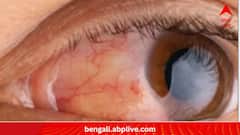 Lifestyle:জানেন কি, গ্লকোমায় দৃষ্টি খোয়ানো রুখতে চিকিৎসার পাশাপাশি জরুরি এগুলিও?