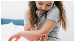 बच्चों को गर्मी में निकल रही है घमौरियों तो जाने इसका घरेलू उपाय