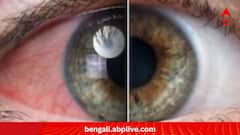 Lifestyle:জানেন কি, গ্লকোমায় দৃষ্টি খোয়ানো রুখতে চিকিৎসার পাশাপাশি জরুরি এগুলিও?