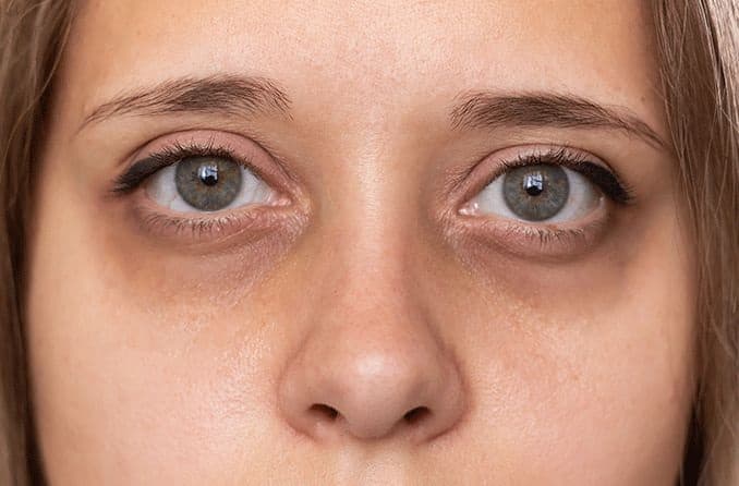 Dark circles will be gone in just 10 days, just try this home remedy Dark Circles:માત્ર 10 દિવસમાં ડાર્ક સર્કલ થશે દૂર, બસ અજમાવી જુઓ ઘરેલુ ઉપાય