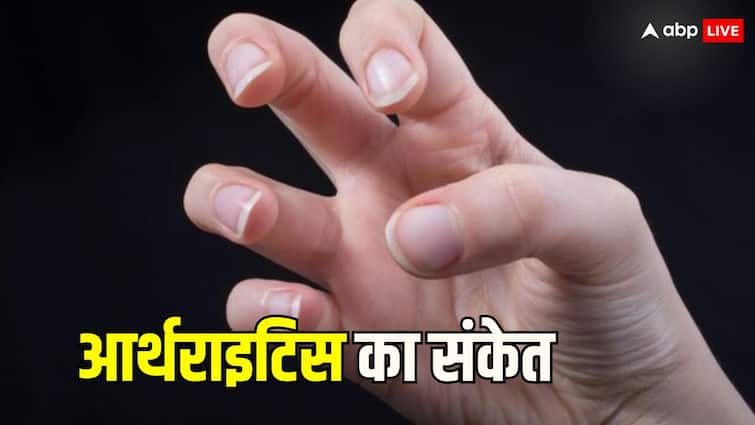 health tips arthritis symptoms and signs on fingers know what to do Arthritis: उंगलियों में 5 तरह की परेशानी नजर आए तो हो जाएं सावधान, हो सकता है अर्थराइटिस