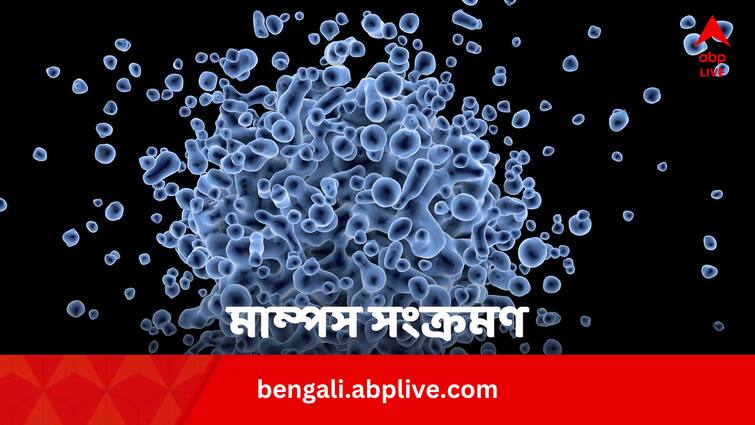 Mumps Outbreak In Delhi And Other States In India Know Signs And Prevention Tips In Bengali Mumps Outbreak In Delhi: দিল্লিসহ গোটা দেশে মাম্পস-আতঙ্ক, সংক্রমণ এড়াতে কী করবেন ?