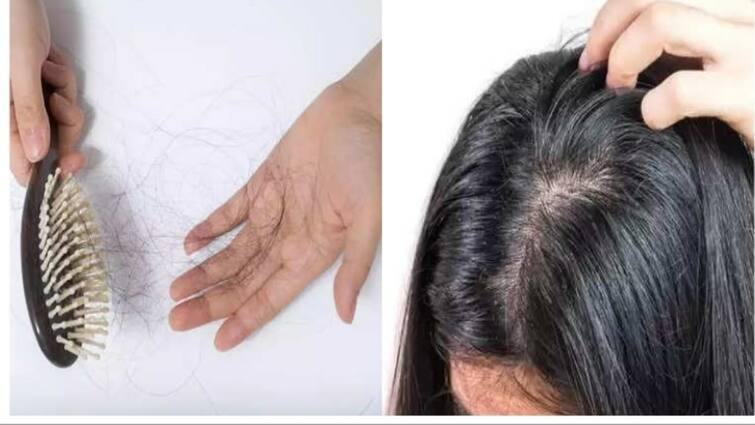 Hair Care Tips in Tamil How to Get Rid of Dandruff and Hairfall Try this to Get Best Result Dandruff and Hair Fall: பொடுகு பிரச்சினையா? முடி உதிர்கிறதா? இதை செய்து பாருங்க! கூந்தலுக்கு நல்ல பலன் கிடைக்கும்..!
