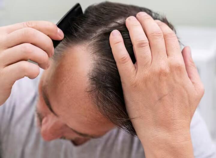 ਜ਼ਿਆਦਾਤਰ ਲੋਕ ਝੜਦੇ ਵਾਲਾਂ ਤੋਂ ਪਰੇਸ਼ਾਨ ਰਹਿੰਦੇ ਹਨ। ਜੇਕਰ ਤੁਸੀਂ ਵੀ ਵਾਲ ਝੜਨ ਦੀ ਸਮੱਸਿਆ ਤੋਂ ਪਰੇਸ਼ਾਨ ਹੋ ਤਾਂ ਇਹ ਖਬਰ ਤੁਹਾਡੇ ਲਈ ਹੈ।