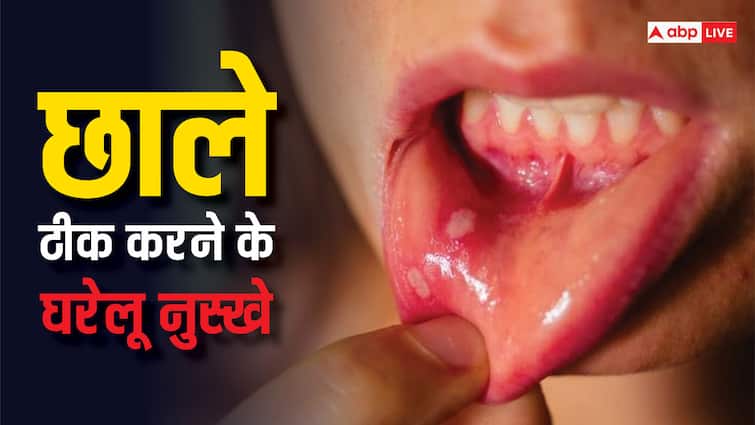 health tips mouth ulcers home remedies muh ke chhale ka  gharelu upay in hindi Mouth Ulcer: छालों से हैं परेशान, पानी भी नहीं पी पा रहे हैं? टेंशन छोड़िए, अपनाएं 5 घरेलू उपाय, तुरंत दिखेगा असर