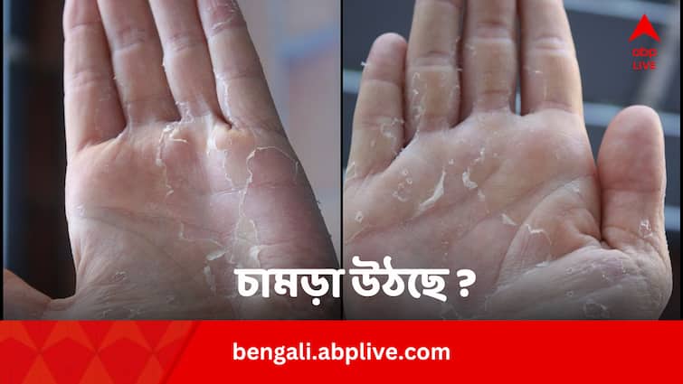 Skin Peeling In Summer Cause Affected Organs Treatment Bengali News