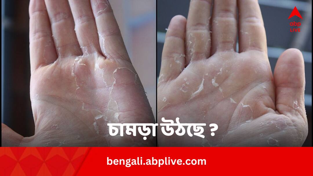 Skin Peeling In Summer: গরমে ত্বকের উপরের পাতলা স্তর উঠে আসছে ? কেন? কীসে সুরাহা ? Skin Peeling In Summer Cause Affected Organs Treatment Bengali News Skin Peeling In Summer: গরমে ত্বকের উপরের পাতলা স্তর উঠে আসছে ? কেন? কীসে সুরাহা ?