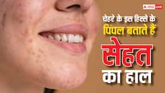 चेहरे के इस हिस्से पर निकल रहे हैं दाने तो हल्के में न लें, जानें कारण और इलाज