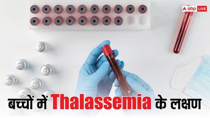 world thalassemia day 2024 know what is thalassemia its causes symptoms and treatment in hindi World Thalassemia Day 2024 : ऐसी बीमारी जिसमें चढ़ाया जाता है बार-बार खून, नहीं बनता हीमोग्लोबिन, बच्चों को ऐसे बचाएं