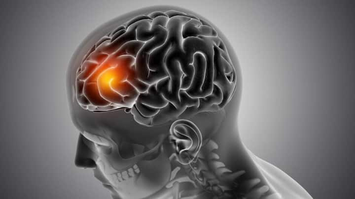 Brain Cancer- ब्रेन कैंसर सिर्फ दिमाग को ही नहीं बल्कि पूरे शरीर को प्रभावित करता है. आइए जानें इसके शुरुआती लक्षण और प्रकार के बारे में विस्तार से.