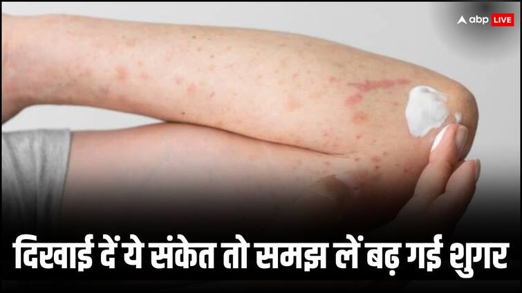 health tips high blood sugar symptoms and signs on skin in hindi Diabetes Symptoms: स्किन पर दिखने वाली इन समस्याओं को हल्के में न लें, हो सकते हैं शुगर बढ़ने के संकेत