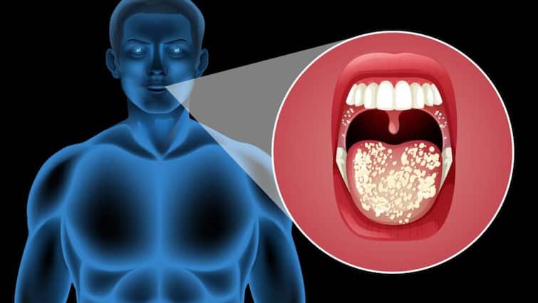 मुंह के छाले भी हो सकते हैं माउथ कैंसर के शुरुआती लक्षण, भूल से भी मत कीजिए नजरअंदाज