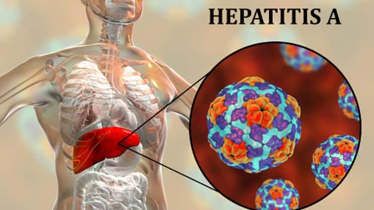 Hepatitis A Outbreak Kerala Contagious Liver Infection Causes Symptoms Diagnosis Prevention Treatment Hepatitis A Outbreak In Kerala: What Causes This Contagious Liver Infection? Know Its Symptoms And Treatment