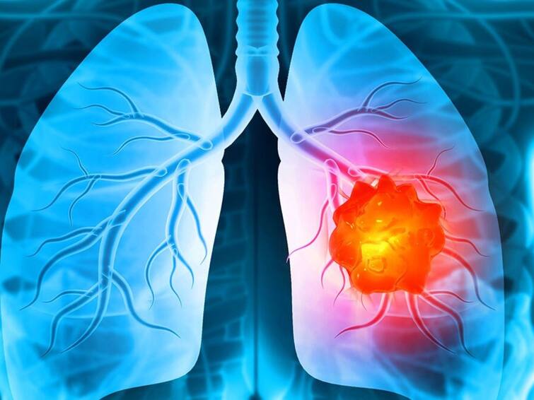 Lung Cancer If these symptoms appear in the body be careful There may be a disease like lung cancer Lung Cancer- ਸਰੀਰ 'ਚ ਇਹ ਲੱਛਣ ਦਿੱਸਣ ਤਾਂ ਹੋ ਜਾਓ ਸਾਵਧਾਨ! ਹੋ ਸਕਦੀ ਹੈ ਫੇਫੜਿਆਂ ਦੇ ਕੈਂਸਰ ਵਰਗੀ ਬਿਮਾਰੀ