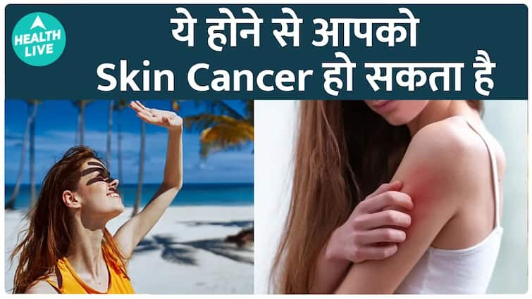 Sunburn कैसे आपके Skin को affect करता है? | Sunburn | Heatstroke | Heat | Health Live| Health Live