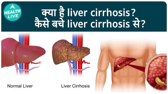 क्या है Live Cirrhosis? कैसे बचे इस बीमारी से? | Health Live