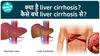 क्या है Live Cirrhosis? कैसे बचे इस बीमारी से? | Health Live