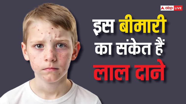 Red rashes and pimples on kids face is skin condition know about herpes infection Herpes In Kid's: एक ही रात में बच्चों के चेहरे पर क्यों हो रहे लाल-लाल दाने, कैसे करें इसका इलाज?