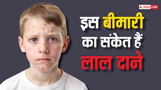 Herpes In Kid's: एक ही रात में बच्चों के चेहरे पर क्यों हो रहे लाल-लाल दाने, कैसे करें इसका इलाज?