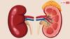 Kidney Dialysis Tips: डायलिसिस के बाद ध्यान नहीं रखेंगे ये बातें तो शरीर को होगा और नुकसान, जानें
