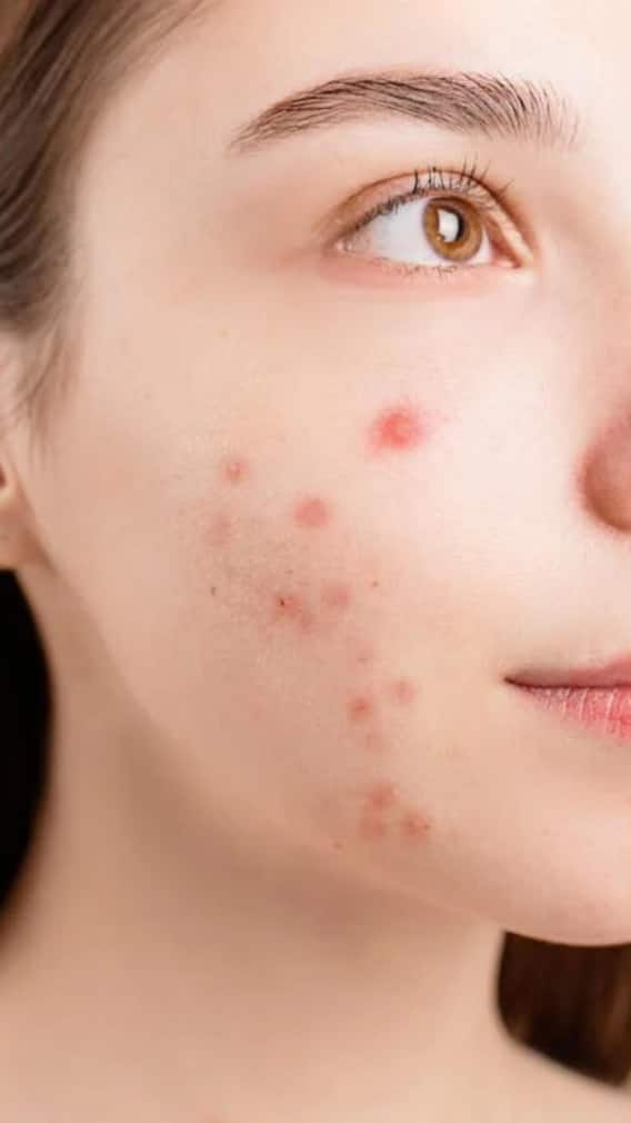 ખીલ-ડાઘ ધબ્બા દૂર કરવા માટેના 5 કુદરતી ઉપાયો જે તરત અસર કરશે