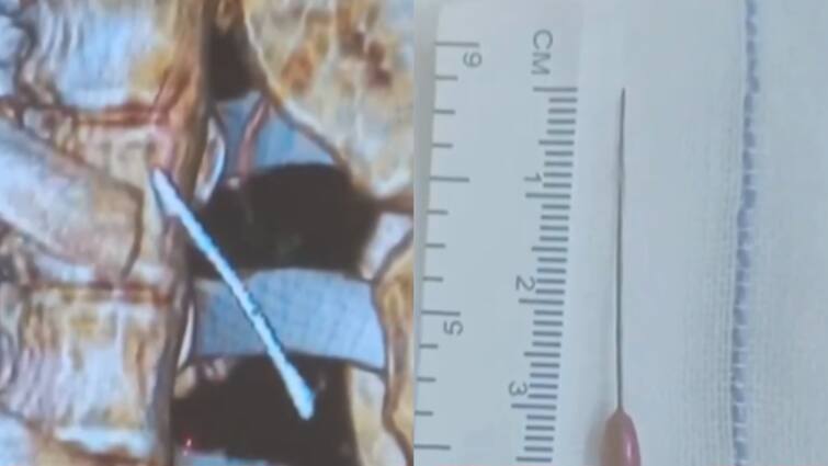 Tamil Nadu Hospital Doctors Remove 1.5 Inch Needle Teen Lung Record Time video Tamil Nadu Hospital Doctors Remove 1.5 Inch Needle From Teen's Lung In Record Time: WATCH