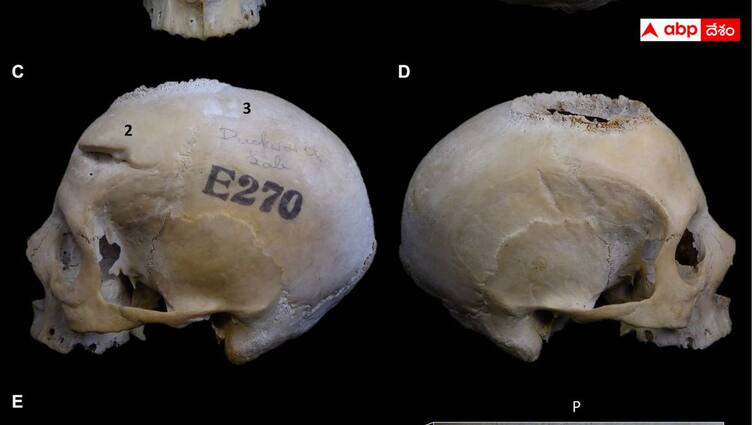 Egyptians Tried To Treat Cancer 4000 Year Old Skull Shows Cancer Treatment: వేల ఏళ్ల క్రితమే క్యాన్సర్‌కి చికిత్స, ఈజిప్టియన్‌లు అద్భుతాలు చేశారా?