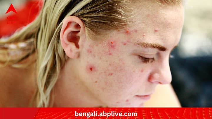যাঁদের ব্রণর সমস্যা রয়েছে, তাঁদের ক্ষেত্রে মাঝারি মানের ঘাম কখনও সখনও উপকারী হতে পারে বলেও মনে করেন বিশেষজ্ঞরা। কারণ ঘামের সঙ্গে সাধারণত ত্বকের কূপে আটকে থাকা অতিরিক্ত তেল, ডেড স্কিন বেরিয়ে আসে। (ছবি:PTI)