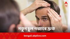 Hair Care Tips: এই পাঁচ খাবারই সুরাহা, নতুন চুল গজাবে দ্রুত