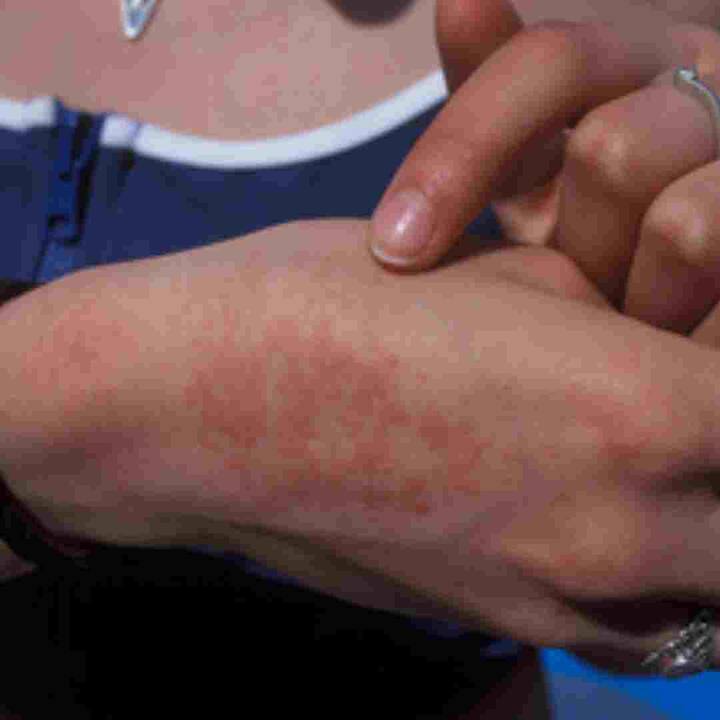 ਗਰਮੀਆਂ ਵਿੱਚ ਗਰਮੀ ਕਾਰਨ ਲੋਕਾਂ ਦਾ ਉੱਠਣਾ-ਬੈਠਣਾ ਵੀ ਔਖਾ ਹੋ ਜਾਂਦਾ ਹੈ। ਇਹ ਸਮੱਸਿਆ ਉਨ੍ਹਾਂ ਲੋਕਾਂ ਲਈ ਜ਼ਿਆਦਾ ਪ੍ਰੇਸ਼ਾਨੀ ਵਾਲੀ ਹੋ ਸਕਦੀ ਹੈ ਜਿਨ੍ਹਾਂ ਦੀ ਚਮੜੀ ਸੰਵੇਦਨਸ਼ੀਲ ਹੁੰਦੀ ਹੈ, ਜਦੋਂ ਗਰਮੀ ਦੇ ਧੱਫੜ ਹੁੰਦੇ ਹਨ, ਤਾਂ ਛੋਟੇ ਮੁਹਾਸੇ ਦਿਖਾਈ ਦਿੰਦੇ ਹਨ ਜੋ ਖੁਜਲੀ ਅਤੇ ਜਲਣ ਸ਼ੁਰੂ ਕਰਦੇ ਹਨ। ਆਓ ਜਾਣਦੇ ਹਾਂ ਇਨ੍ਹਾਂ ਹੀਟ ਰੈਸ਼ਸ ਤੋਂ ਕਿਵੇਂ ਬਚਿਆ ਜਾ ਸਕਦਾ ਹੈ।