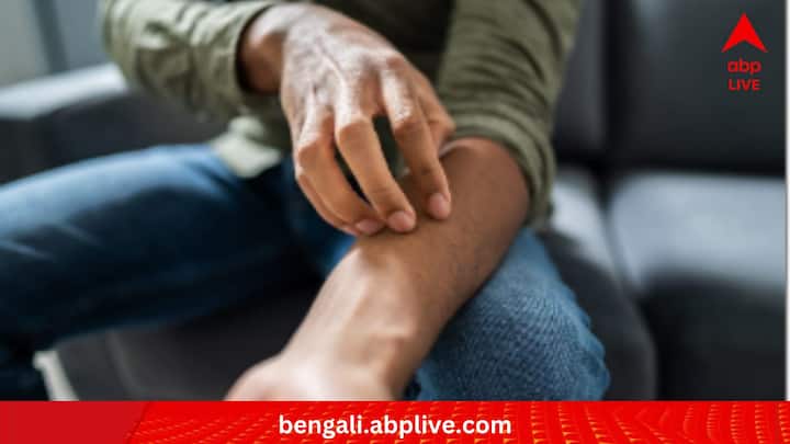 কিন্তু অতিরিক্ত ঘাম হিতে বিপরীত করতে পারে, এমনও সতর্ক করেন ডার্মাটোলজিস্টরা। কীরকম? ডার্মাটাইটিস, ত্বকে চুলকানি, শুষ্কতার সমস্যা বাড়তে পারে।