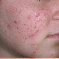 Skin Problem : ਕੀ ਤੁਸੀਂ ਵੀ ਮੁਹਾਂਸਿਆਂ ਤੋਂ ਪ੍ਰੇਸ਼ਾਨ ਤਾਂ ਹੋ ਸਕਦੇ ਹਨ ਆਹ ਕਾਰਣ