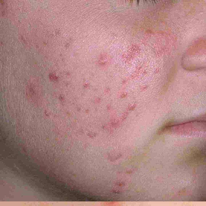 ਡਾਇਟੀਸ਼ੀਅਨ ਨਮਾਮੀ ਅਗਰਵਾਲ ਦਾ ਕਹਿਣਾ ਹੈ ਕਿ ਜ਼ਿਆਦਾ ਖੰਡ ਬਹੁਤ ਨੁਕਸਾਨਦੇਹ ਹੈ। ਕੈਂਡੀ, ਪੇਸਟਰੀ ਜਾਂ ਆਰਟੀਫਿਸ਼ੀਅਲ ਸ਼ੂਗਰ ਤੋਂ ਬਣੀਆਂ ਹੋਰ ਚੀਜ਼ਾਂ ਖਾਣ ਨਾਲ ਸਰੀਰ ਵਿੱਚ ਇਨਸੁਲਿਨ ਦਾ ਪੱਧਰ ਵੱਧ ਜਾਂਦਾ ਹੈ। ਇਸ ਨਾਲ ਚਮੜੀ 'ਚ ਤੇਲ ਦਾ ਉਤਪਾਦਨ ਵਧਦਾ ਹੈ। ਇਸ ਦੇ ਕਾਰਨ, ਚਮੜੀ ਦੇ follicles ਅਤੇ pores ਸੀਬਮ ਨਾਲ ਭਰ ਜਾਂਦੇ ਹਨ ਅਤੇ ਮੁਹਾਸੇ ਬਣ ਜਾਂਦੇ ਹਨ।