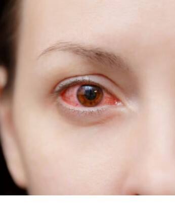 Eye Infection Spreading in Tamil Nadu: Expert Advice and Prevention Tips Eye Infection : “கண் சிவப்பு, உறுத்தல், எரிச்சல், நீர் வடிதலா?” பரவுகிறது புதிய வகை காய்ச்சல்..!