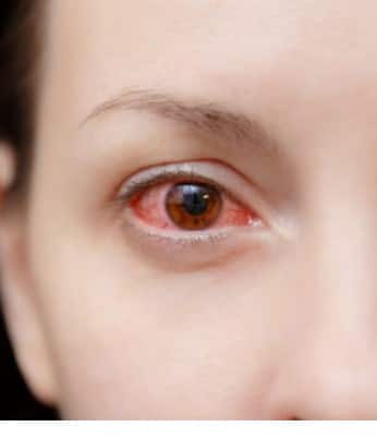Eye Infection Spreading in Tamil Nadu: Expert Advice and Prevention Tips Eye Infection : “கண் சிவப்பு, உறுத்தல், எரிச்சல், நீர் வடிதலா?” பரவுகிறது புதிய வகை காய்ச்சல்..!