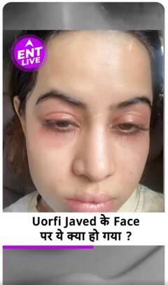 Uorfi Javed Swollen Face, Uorfi Javed Latest Post, Botox, Face Surgery , Uorfi Alleries