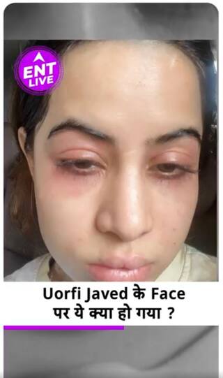 Uorfi Javed Swollen Face, Uorfi Javed Latest Post, Botox, Face Surgery , Uorfi Alleries