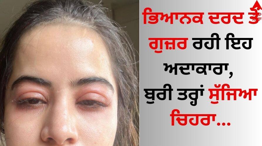 Urfi Javed Shares Photo Of Swollen Face, Claims It's Allergies know details Actress: ਭਿਆਨਕ ਦਰਦ ਤੋਂ ਗੁਜ਼ਰ ਰਹੀ ਇਹ ਅਦਾਕਾਰਾ, ਬੁਰੀ ਤਰ੍ਹਾਂ ਸੁੱਜਿਆ ਚਿਹਰਾ