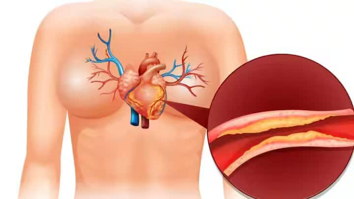 निर्जलीकरण के कारण लीवर रक्त में अधिक कोलेस्ट्रॉल का उत्पादन करता है। अगर आप अधिक पानी पीते हैं तो हाई कोलेस्ट्रॉल नियंत्रण में रहता है। इसके अलावा मरीजों को फाइबर और प्रोटीन से भरपूर भोजन का सेवन करना चाहिए।